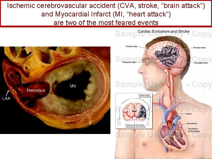 Ischemic cerebrovascular accident (CVA, stroke, “brain attack”) and Myocardial Infarct (MI, “heart attack”) are