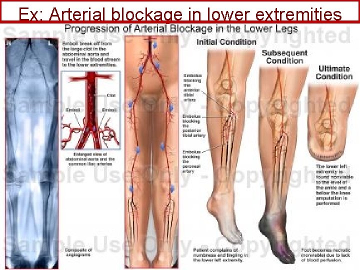 Ex: Arterial blockage in lower extremities 