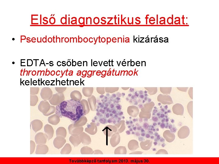 Első diagnosztikus feladat: • Pseudothrombocytopenia kizárása • EDTA-s csőben levett vérben thrombocyta aggregátumok keletkezhetnek