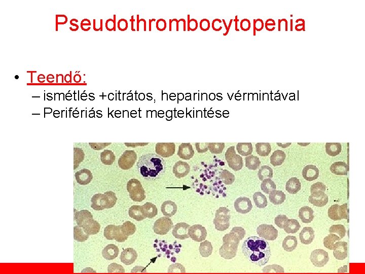 Pseudothrombocytopenia • Teendő: – ismétlés +citrátos, heparinos vérmintával – Perifériás kenet megtekintése Továbbképző tanfolyam