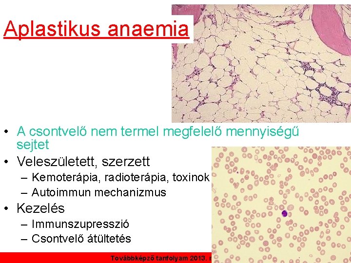 Aplastikus anaemia • A csontvelő nem termel megfelelő mennyiségű sejtet • Veleszületett, szerzett –