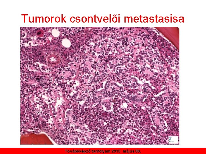 Tumorok csontvelői metastasisa Továbbképző tanfolyam 2013. május 30. 