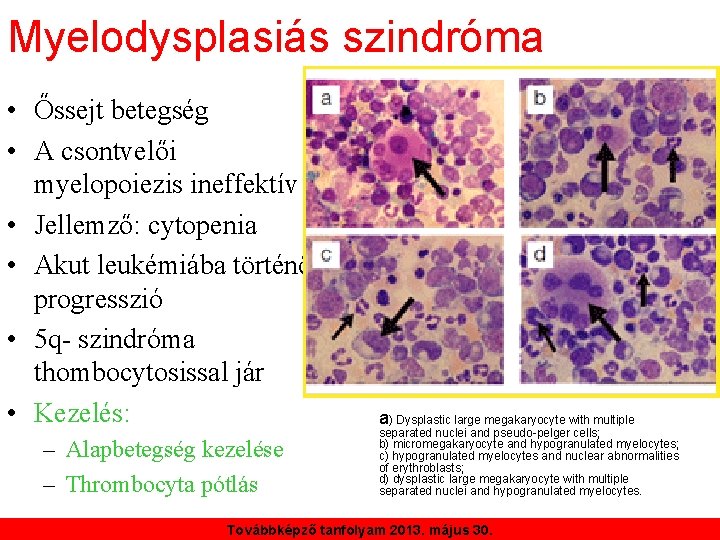 Myelodysplasiás szindróma • Őssejt betegség • A csontvelői myelopoiezis ineffektív • Jellemző: cytopenia •