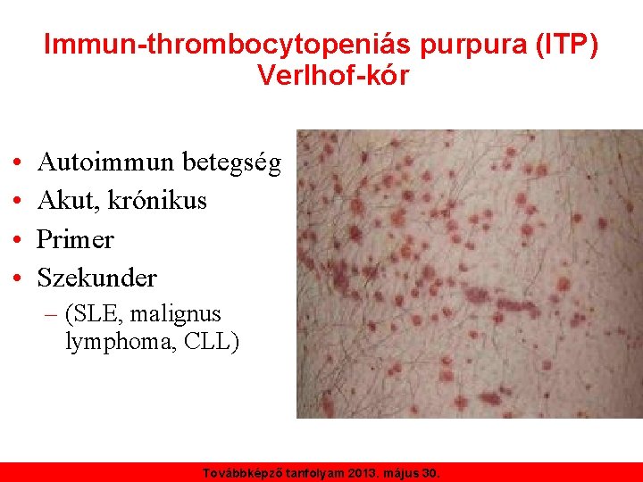 Immun-thrombocytopeniás purpura (ITP) Verlhof-kór • • Autoimmun betegség Akut, krónikus Primer Szekunder – (SLE,
