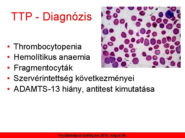 TTP - Diagnózis • • • Thrombocytopenia Hemolítikus anaemia Fragmentocyták Szervérintettség következményei ADAMTS-13 hiány,