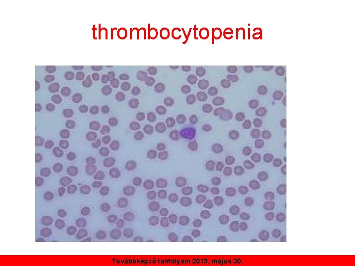 thrombocytopenia Továbbképző tanfolyam 2013. május 30. 