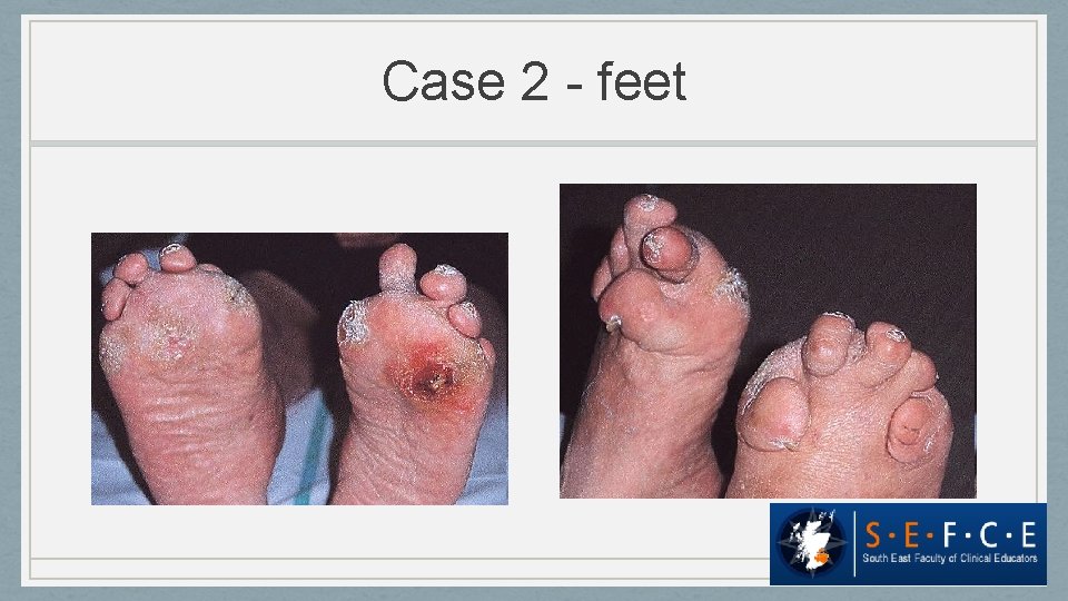 Case 2 - feet 