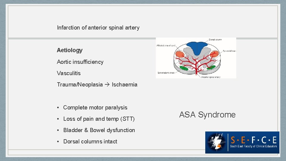 Infarction of anterior spinal artery Aetiology Aortic insufficiency Vasculitis Trauma/Neoplasia Ischaemia • Complete motor