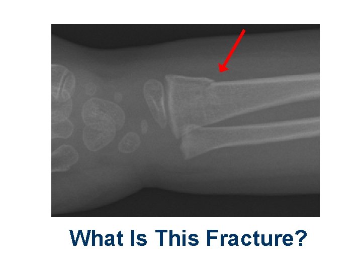 What Is This Fracture? 