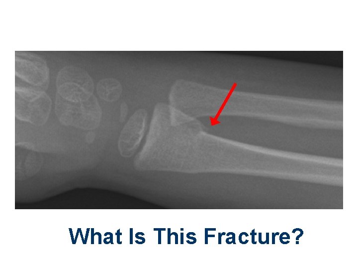 What Is This Fracture? 