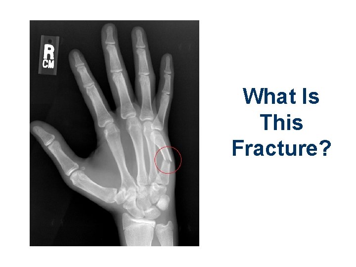 What Is This Fracture? 