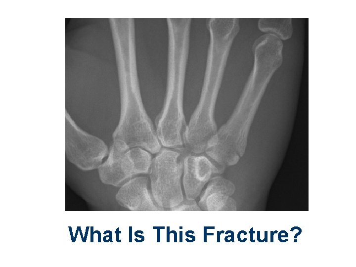 What Is This Fracture? 