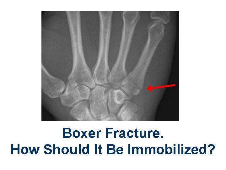 Boxer Fracture. How Should It Be Immobilized? 