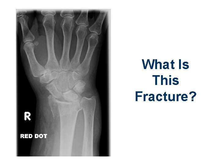 What Is This Fracture? 