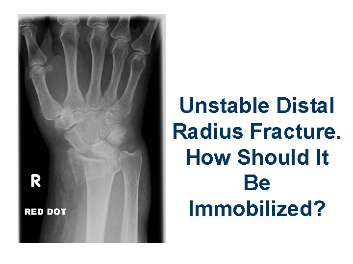 Unstable Distal Radius Fracture. How Should It Be Immobilized? 