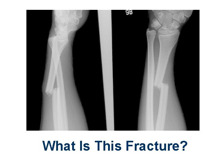 What Is This Fracture? 