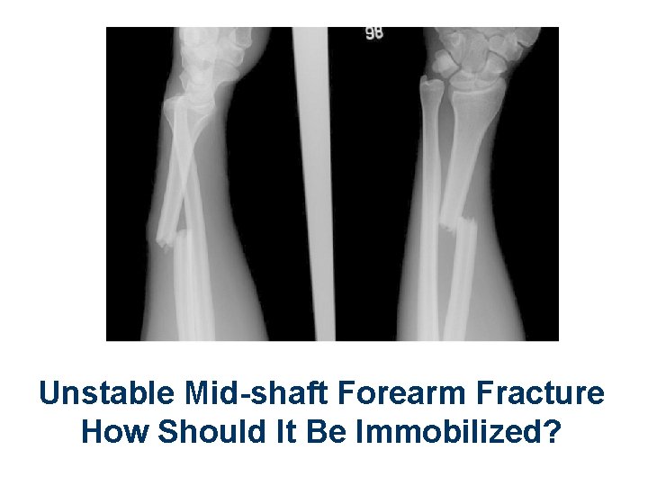 Unstable Mid-shaft Forearm Fracture How Should It Be Immobilized? 