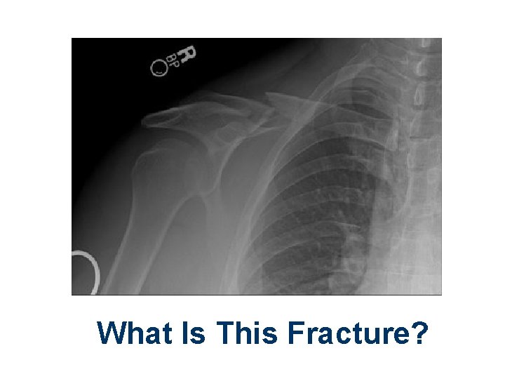What Is This Fracture? 
