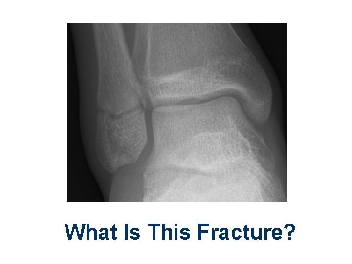 What Is This Fracture? 