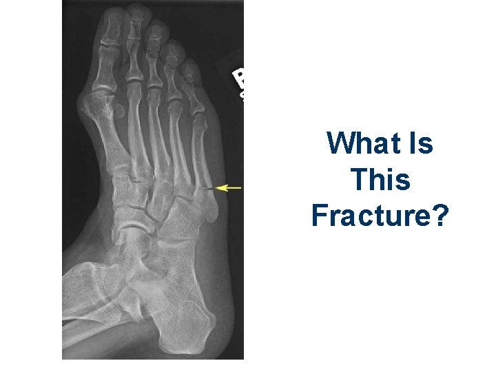 What Is This Fracture? 