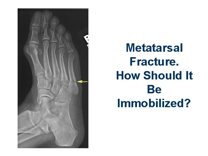 Metatarsal Fracture. How Should It Be Immobilized? 