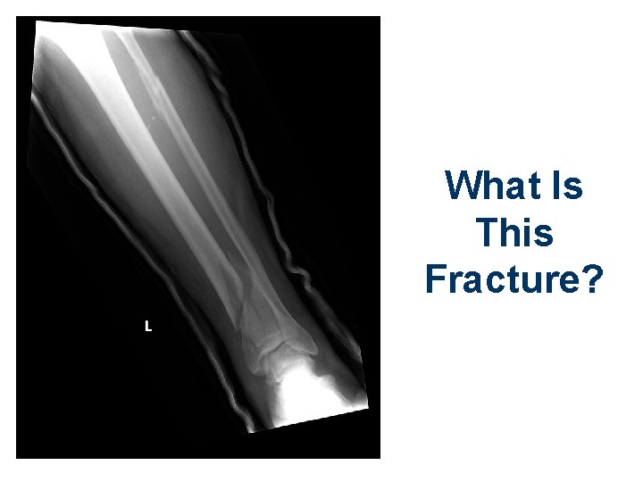 What Is This Fracture? 