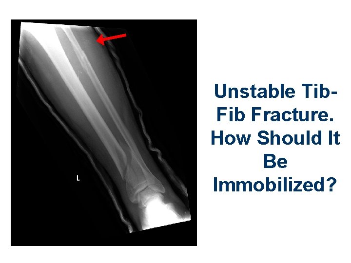 Unstable Tib. Fib Fracture. How Should It Be Immobilized? 