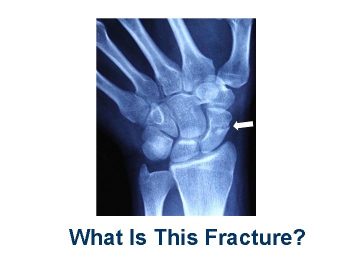 What Is This Fracture? 