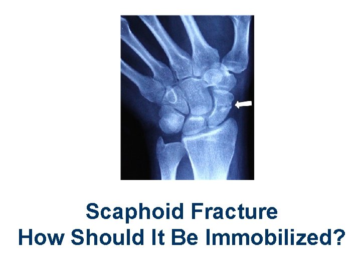 Scaphoid Fracture How Should It Be Immobilized? 