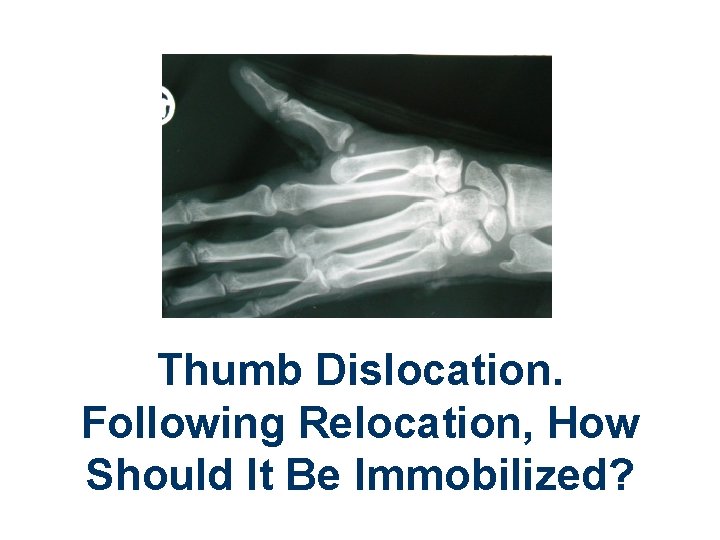 Thumb Dislocation. Following Relocation, How Should It Be Immobilized? 