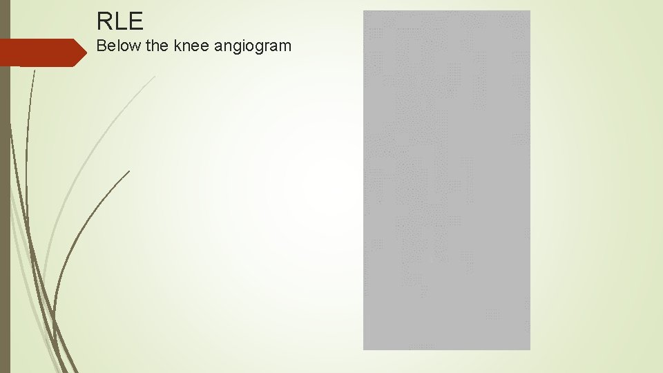 RLE Below the knee angiogram 
