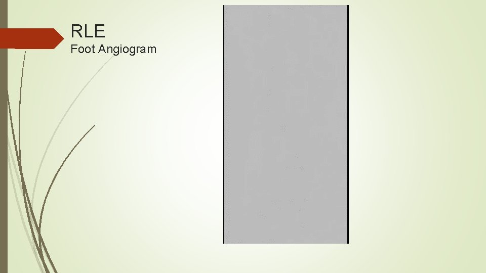 RLE Foot Angiogram 
