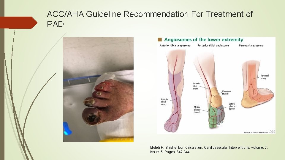 ACC/AHA Guideline Recommendation For Treatment of PAD Mehdi H. Shishehbor. Circulation: Cardiovascular Interventions. Volume: