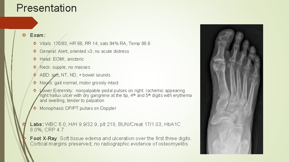 Presentation Exam: Vitals: 170/83, HR 68, RR 14, sats 94% RA, Temp 98. 6