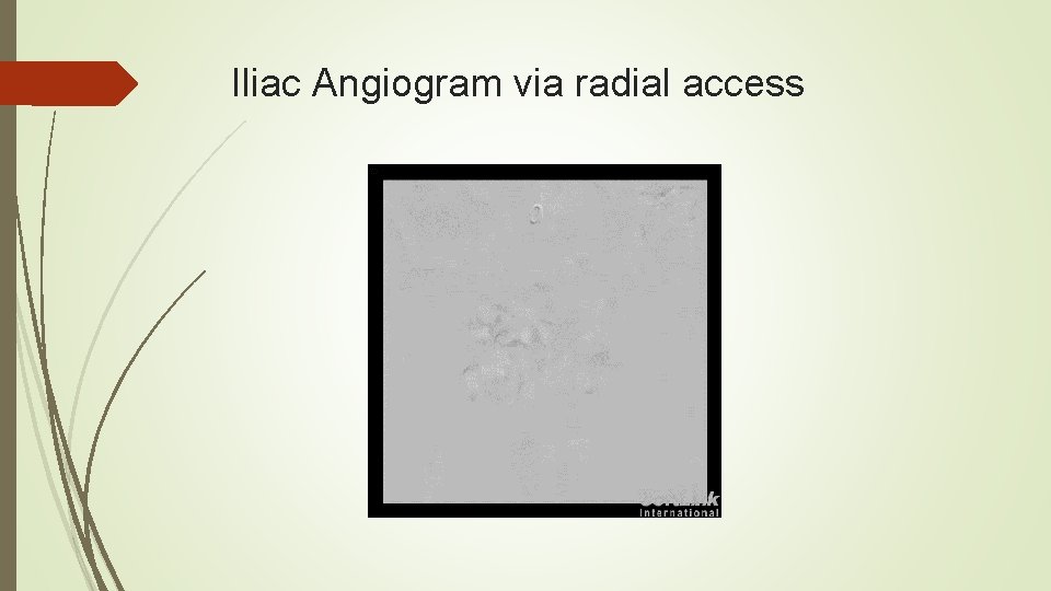 Iliac Angiogram via radial access 