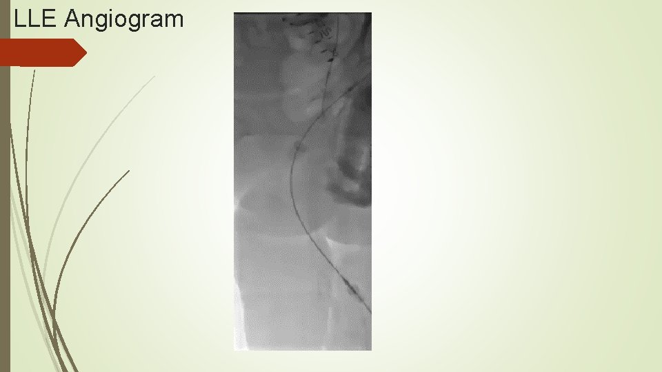 LLE Angiogram 