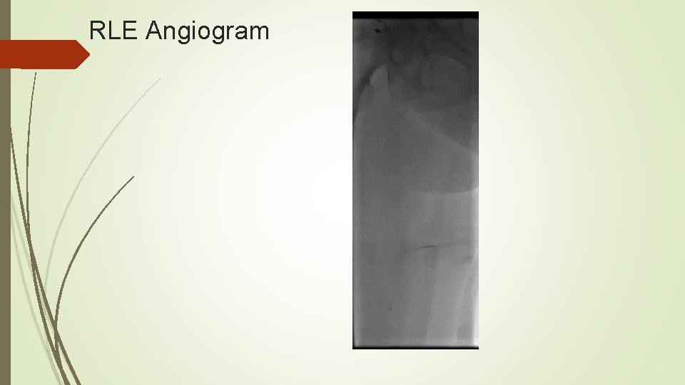 RLE Angiogram 