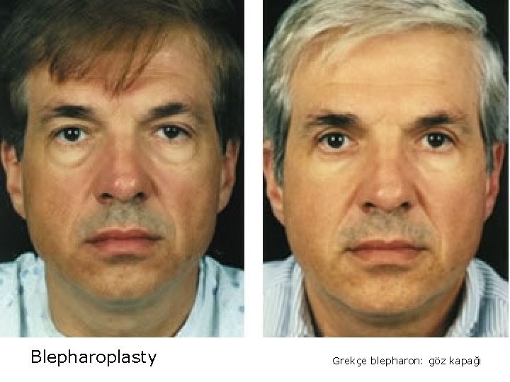 Blepharoplasty Grekçe blepharon: göz kapağı 