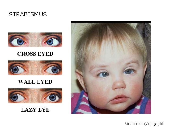 STRABISMUS Strabismos (Gr): şaşılık 