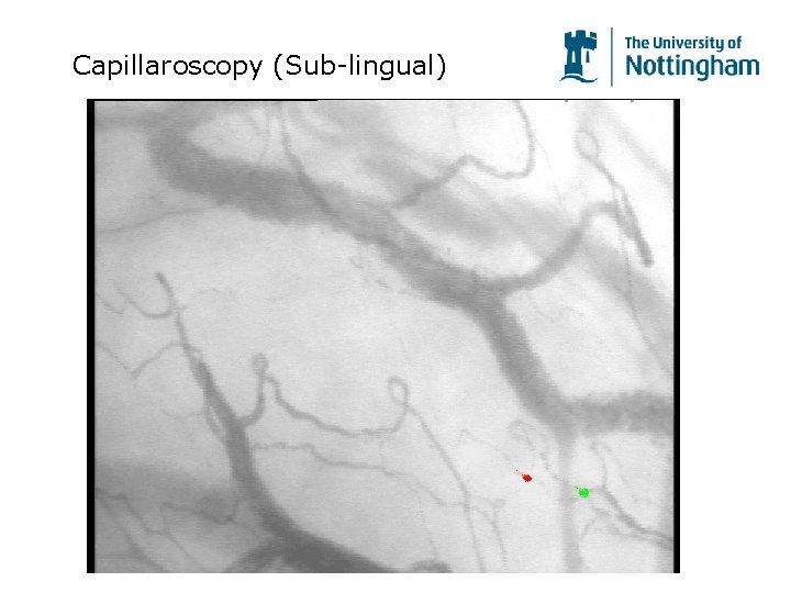 Capillaroscopy (Sub-lingual) Capillaroscopy (Sub-lingual)