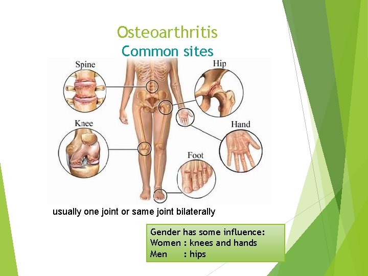 Osteoarthritis Common sites usually one joint or same joint bilaterally Gender has some influence: