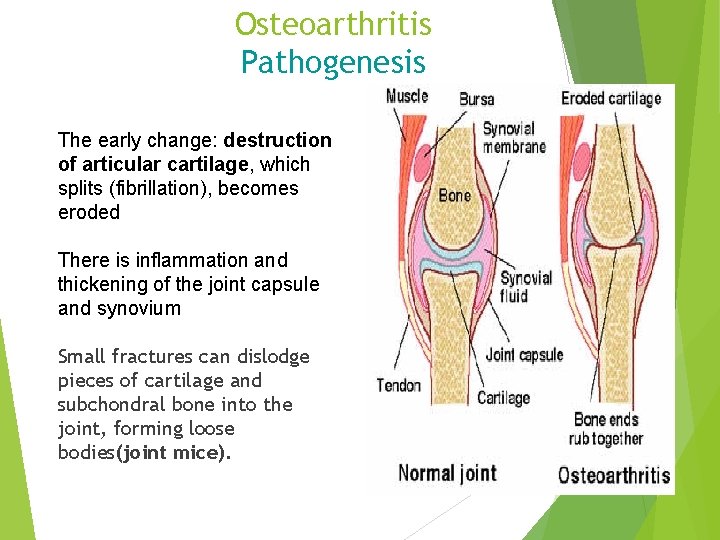 Osteoarthritis Pathogenesis The early change: destruction of articular cartilage, which splits (fibrillation), becomes eroded