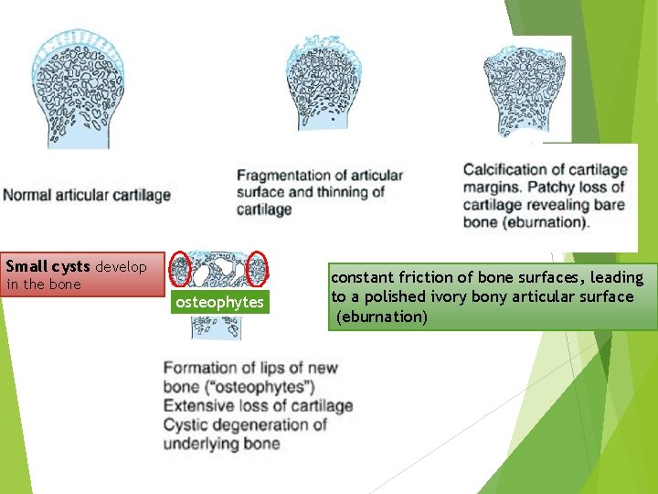 Small cysts develop in the bone osteophytes constant friction of bone surfaces, leading to