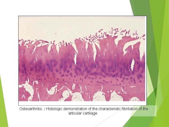 Osteoarthritis. : Histologic demonstration of the characteristic fibrillation of the articular cartilage. 