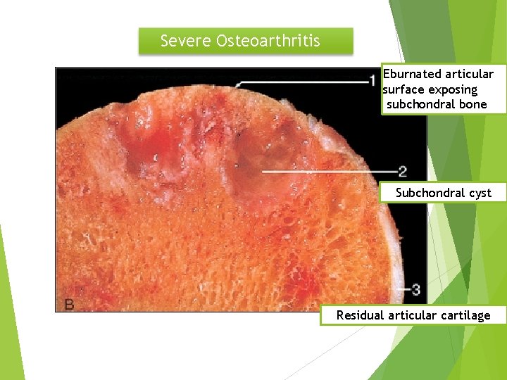 Severe Osteoarthritis Eburnated articular surface exposing subchondral bone Subchondral cyst Residual articular cartilage 