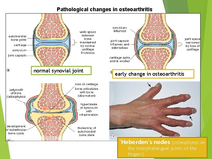 Pathological changes in osteoarthritis normal synovial joint early change in osteoarthritis 'Heberden's nodes (osteophytes