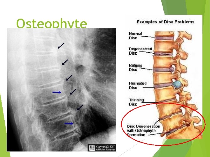 Osteophyte 