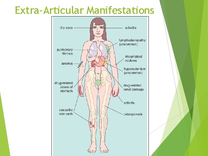 Extra-Articular Manifestations 