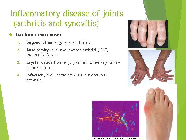 Inflammatory disease of joints (arthritis and synovitis) has four main causes 1. Degeneration, e.