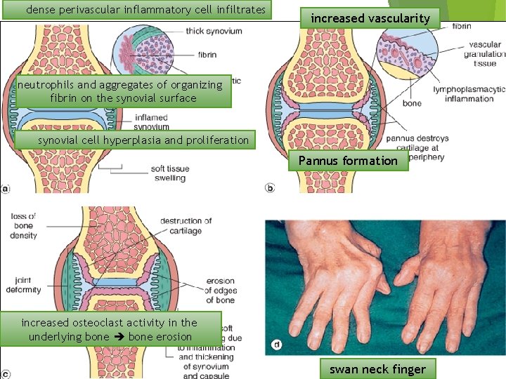 dense perivascular inflammatory cell infiltrates increased vascularity neutrophils and aggregates of organizing fibrin on